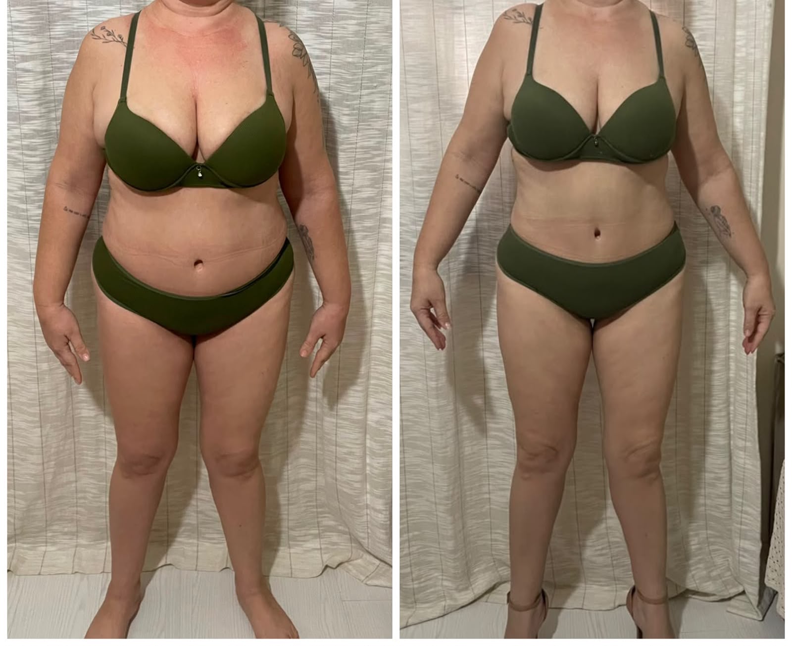 Antes e depois do Body Harmony — vista frontal