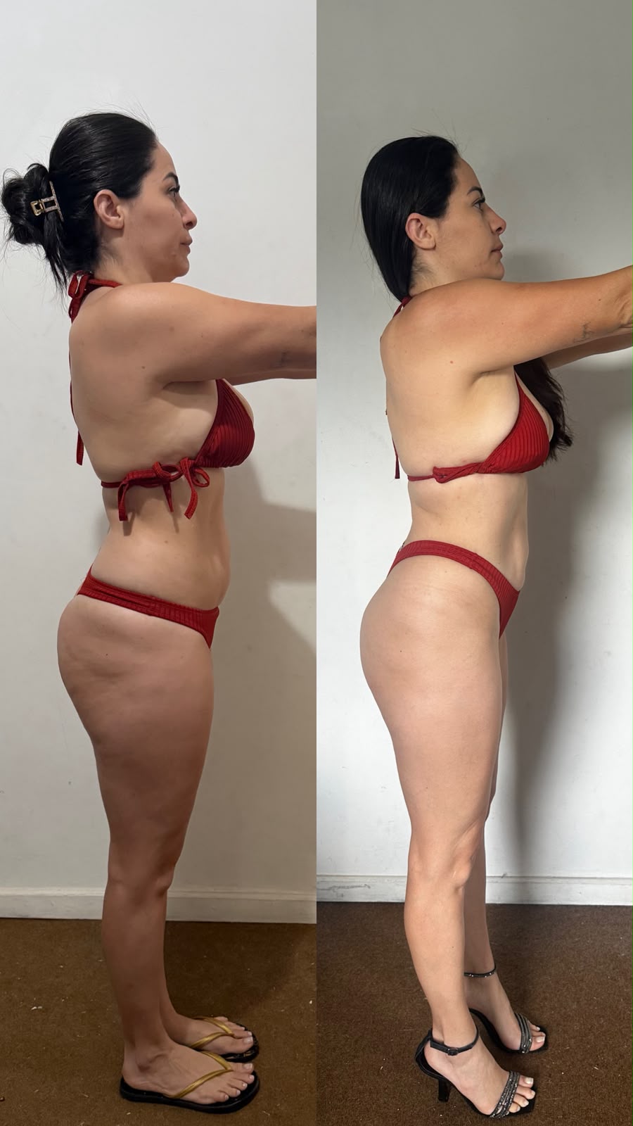 Antes e depois do Body Harmony — vista lateral